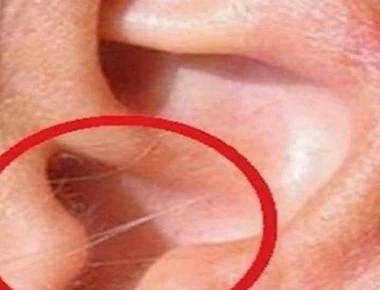 Μεγάλη προσοχή: Δείτε τι σημαίνει αν έχετε τριχοφυΐα στο συγκεκριμένο σημείο του αυτιού!